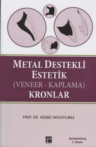 Metal Destekli Estetik (Veneer-Kaplama) Kronlar